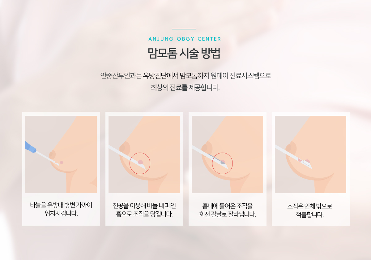 맘모톰 시술 방법
					안중산부인과에서는 유방진단에서 맘모톰까지
					원데이 진료시스템으로 최상의 진료를 제공합니다.

					1. 바늘을 유방내 병변 가까이 위치시킵니다.
					2. 진공을 이용하여 바늘내 페인 홈으로 조직을 당깁니다.
					3. 홈내에 들어온 조직을 회전 칼날로 잘라냅니다.
					4. 조직을 인체 밖으로 적출합니다.